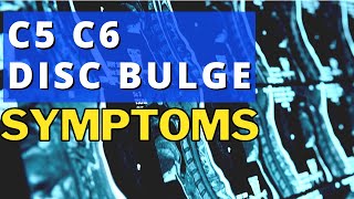 What Are The Symptoms Of A Bulging Disc In The Neck C5 C6 Disc Bulge Symptoms  Dr Walter Salubro [upl. by Halimak998]