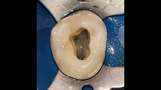 Access opening of Maxillary Molar [upl. by Nylodnarb]