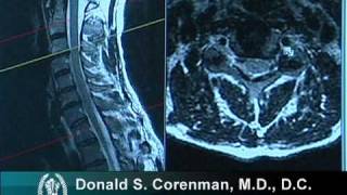 How to Read a MRI of Cervical Nerve Compression  Neck Pain  Colorado Spine Surgeon [upl. by Harutek983]