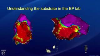 Ablation for AV Node Reentrant Tachycardia AVNRT [upl. by Jumbala]