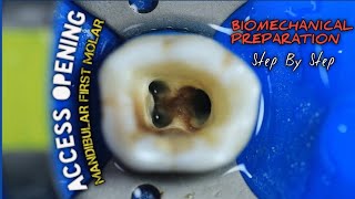 Access Opening Mandibular First Molar  Biomechanical Preparation  step by step [upl. by Eilloh]