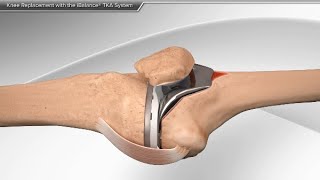 Knee Replacement with the iBalance TKA System [upl. by Annazor]