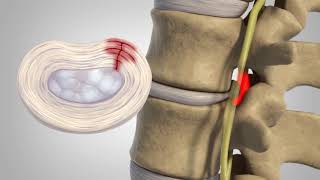 Herniated Disc  Patient Education [upl. by Aiehtela]