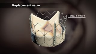 How It Works Transcarotid Artery Revascularization TCAR [upl. by Previdi]