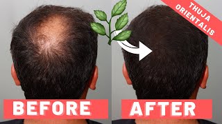 Thuja Orientalis For Hair Loss [upl. by Stallworth]