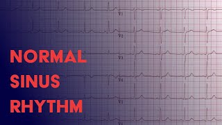 Normal Sinus Rhythm  EKG ECG Interpretation [upl. by Eanar]