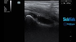 Identifying a Hip Effusion Using POCUS [upl. by Htbazile]