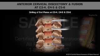 Anterior Cervical Discectomy amp Fusion at C34 C45 amp C56 [upl. by Nuahsel]