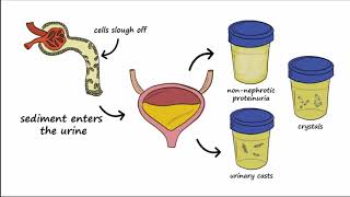 Analgesic Nephropathy AN Kidney Damage from NSAIDs [upl. by Leahcimnaj]