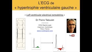 7a L’ECG de lhypertrophie ventriculaire gauche HVG Basic Dr Taboulet [upl. by Winzler959]