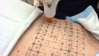 Thermage Treatment of the Abdomen  Dr Michael Kaminer [upl. by Pavlish589]