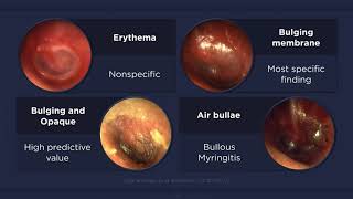 Acute Otitis Media Otoscopic Findings [upl. by Glad]