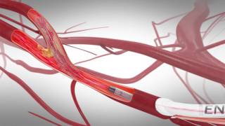 TransCarotid Artery Revascularization TCAR  How I Do It [upl. by Leiser]