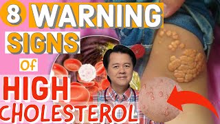 8 Warning Signs of High Cholesterol  By Doc Willie Ong 1098 [upl. by Othella]