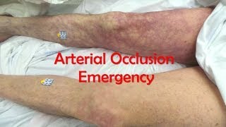 Acute Complete Occlusion of the Leg Arteries [upl. by Heeley]