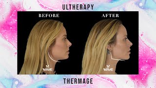 Ultherapy vs Thermage Non Surgical Facelift with Collagen Stimulation  Wave Plastic Surgery [upl. by Ilegna521]