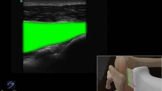 How To Shoulder Injection Lateral Approach 3D Video [upl. by Hi177]