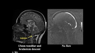 Cine MRI for Chiari I Malformation [upl. by Frisse486]