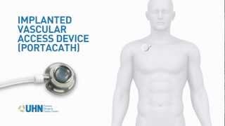 HOW TO ACCESS A PORTACATH IMPLANTED PORT [upl. by Adnalahs]