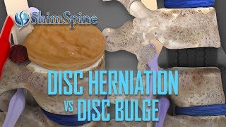 Disc Herniation vs Disc Bulge [upl. by Derril]