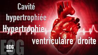 Hypertrophie ventriculaire droite [upl. by Cynthea]